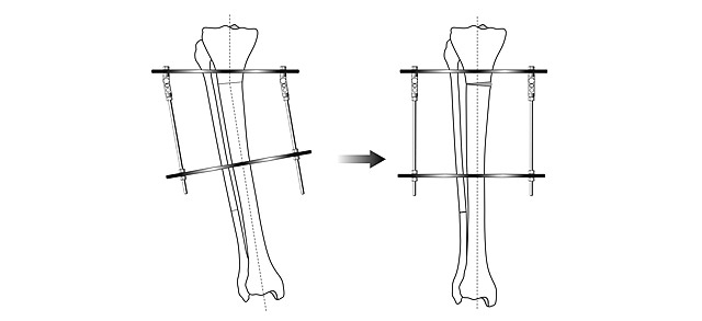 Scheme of angular correction in the Ilizarov apparatus
