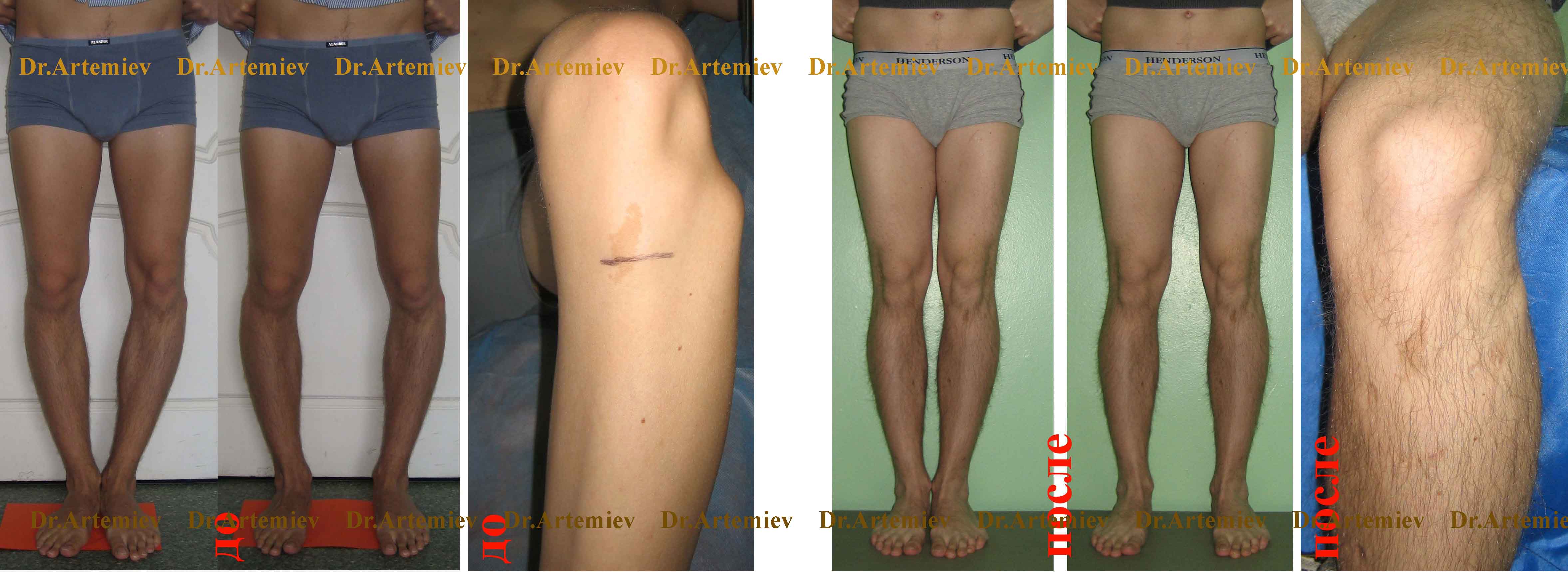 Appearance of a 26-year-old man before and after correction (varus correction + lowering of the fibular head + 1.5-cm leg lengthening)