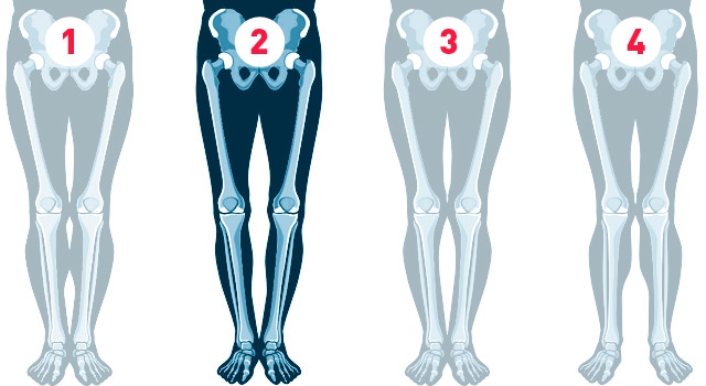 Correction of varus deformity of the lower legs