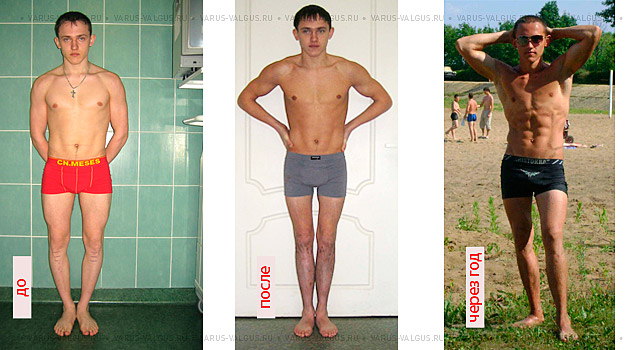 Man before, six months and one year after combined leg-shape correction (O-curvature correction + medialization + 4.5-cm lengthening)