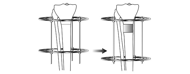Scheme of limb lengthening with the Ilizarov apparatus