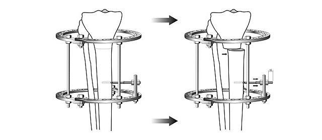 Scheme of tibial medialization