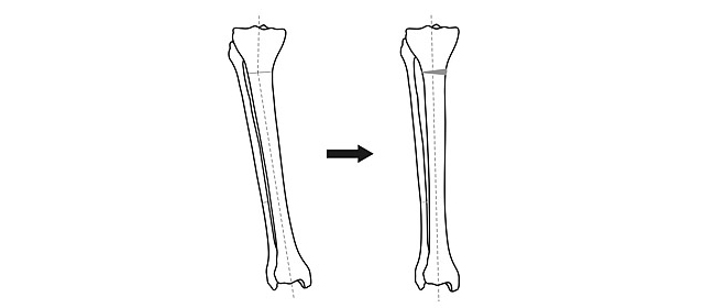 Scheme of tibial axis correction