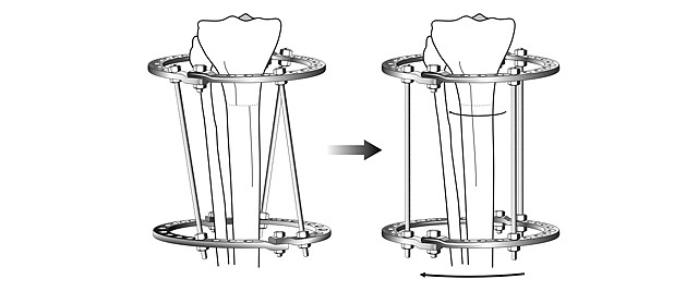Scheme of rotational correction in the Ilizarov apparatus