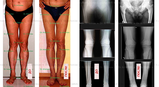 Appearance and X-rays of a 56-year-old man with X-shaped legs before treatment and after correction (leg-shape correction + 4 cm lengthening)