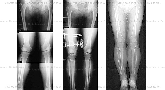 X-rays of a man with post-traumatic valgus deformity of the right thigh before surgery, during correction with the Ilizarov apparatus and after treatment